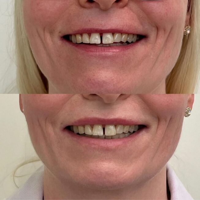 botox-lip-flip-hinta-270-euroa-vmestetiikka-essi-ojala