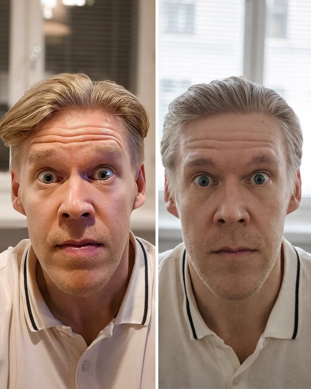 botox miehelle ennen jälkeen