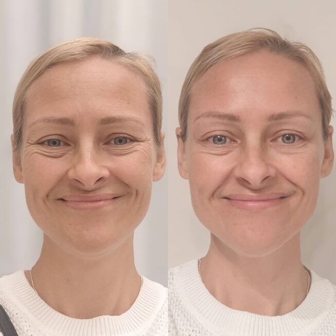 botox-otkokemuksia-ville-mannisto