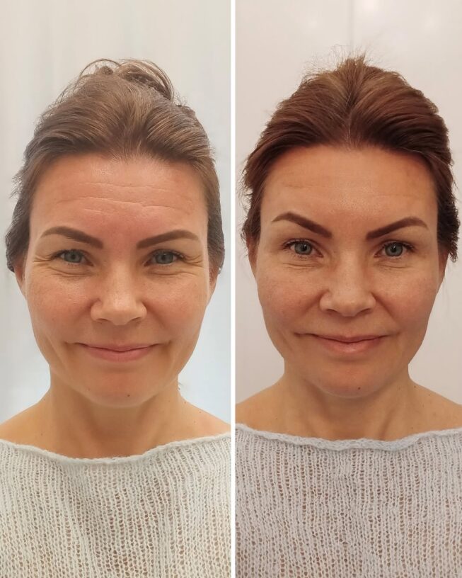 botox-otsa-ennen-jalkeen-1