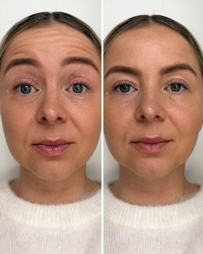 botox-otsa-ennen-jalkeen-3