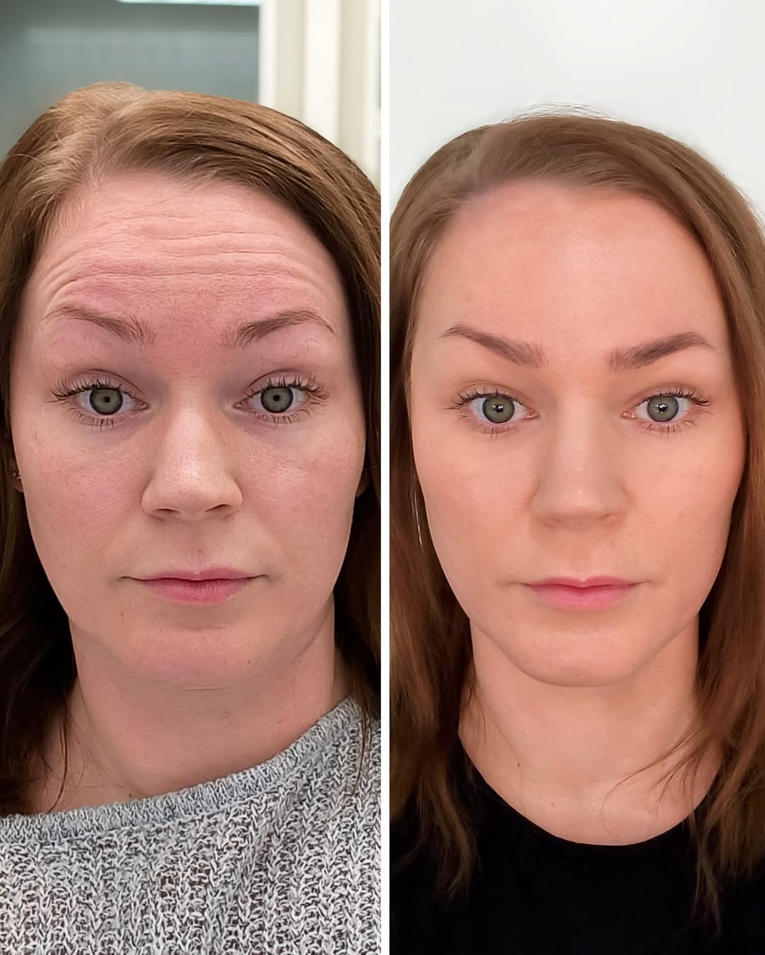 botox otsaan ennen jälkeen