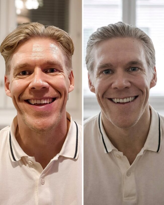 botox-otsa-ennen-jalkeen-5
