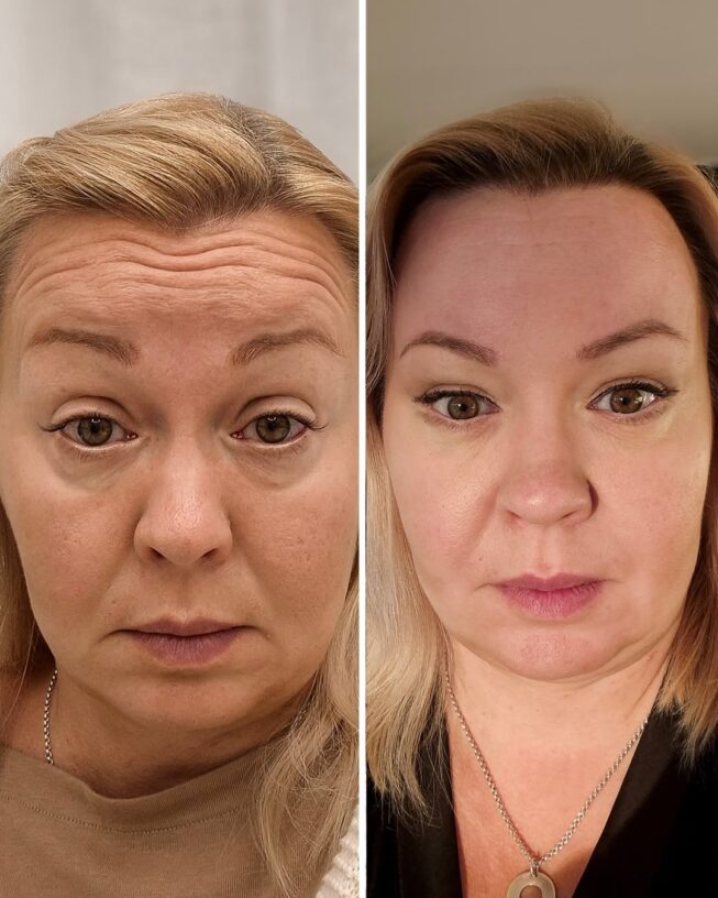 botox-otsa-ennen-jalkeen-6