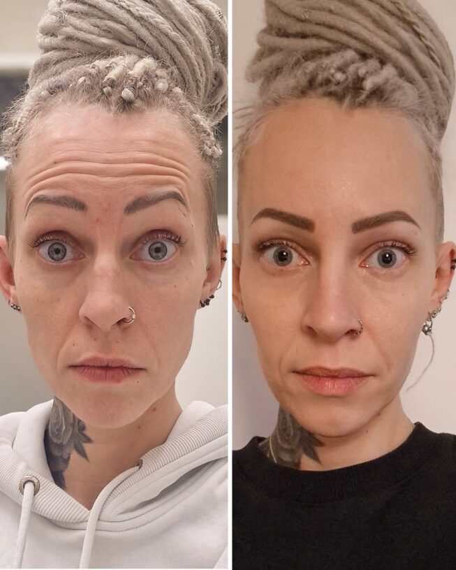 botox-otsa-ennen-jalkeen-7