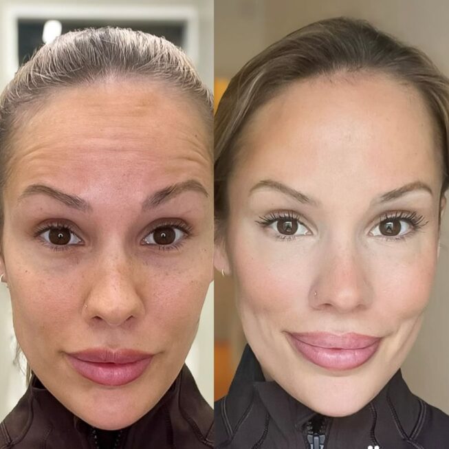 botox-otsa-ville-mannisto