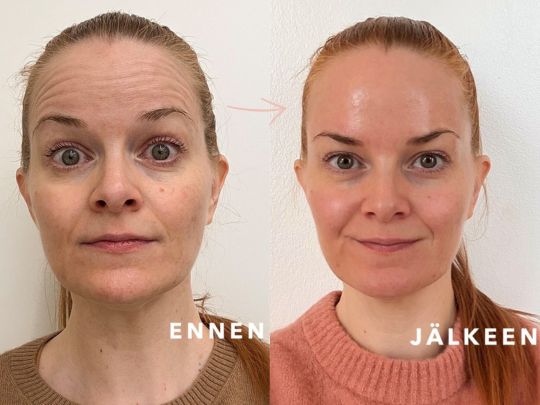 botox otsaan ennen ja jälkeen Ville Männistö