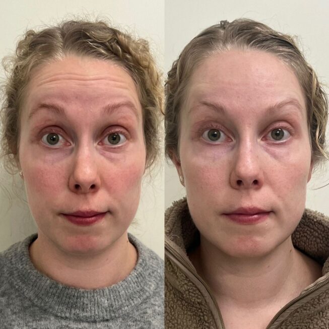 botox-otsaan-essi-ojala (1)