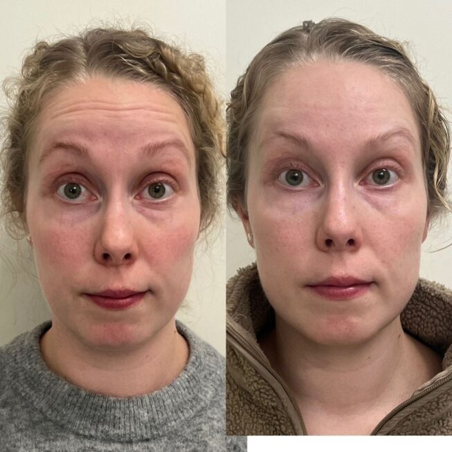 botox-otsaan-essi-ojala