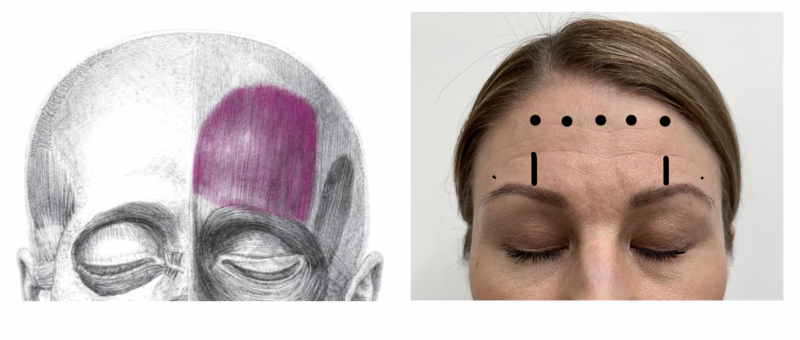 botox otsaan pistoskohdat