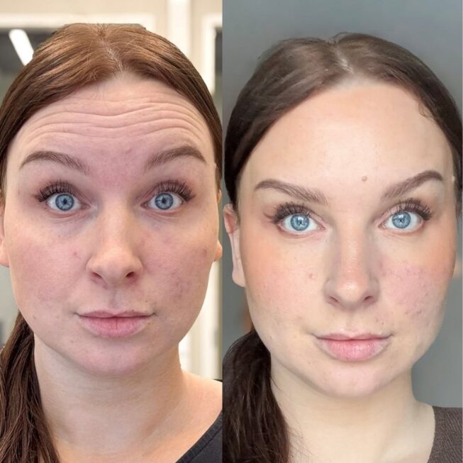 botox-otsaan-ville-mannisto-10