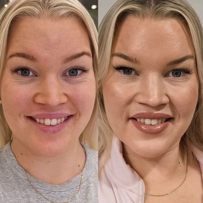 botox-otsaan-ville-mannisto-11