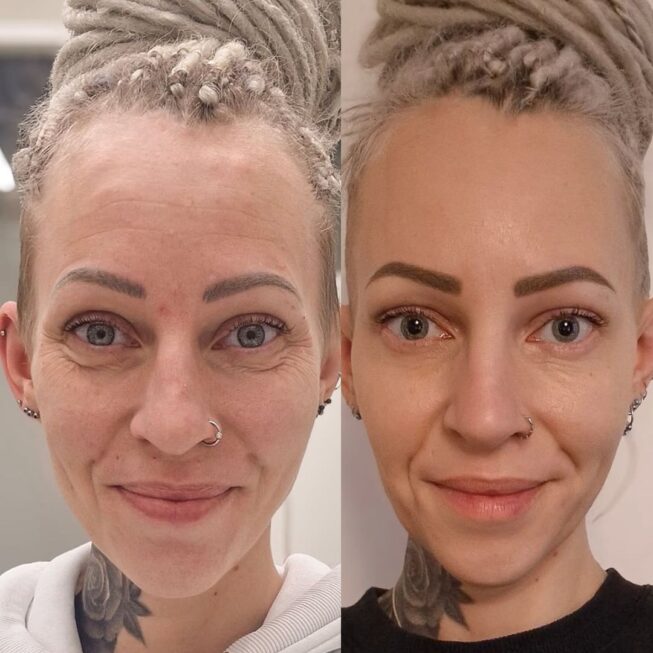 botox-otsaan-ville-mannisto-12