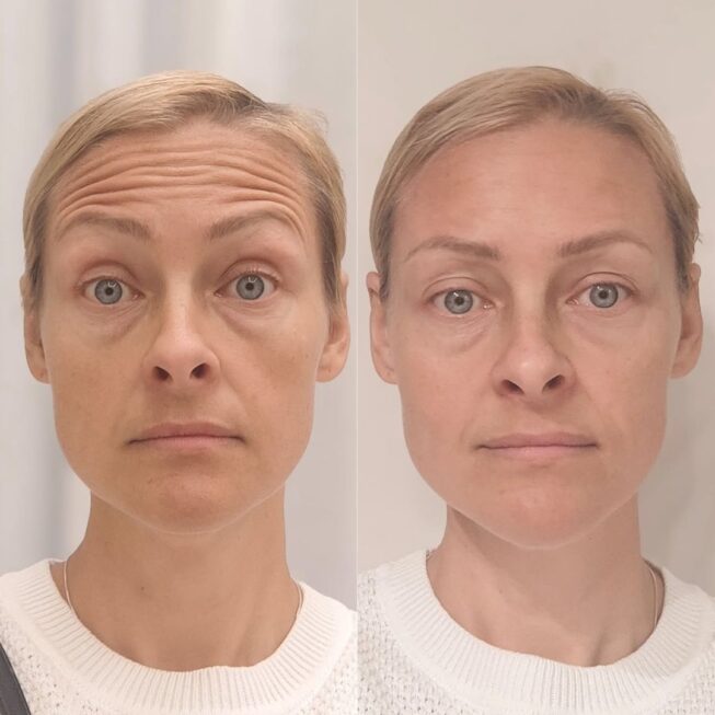 botox-otsaan-ville-mannisto-13