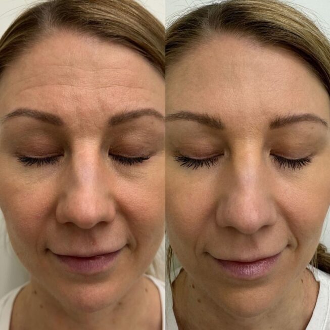 botox-otsaan-ville-mannisto-2