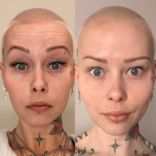 botox-otsaan-ville-mannisto-4