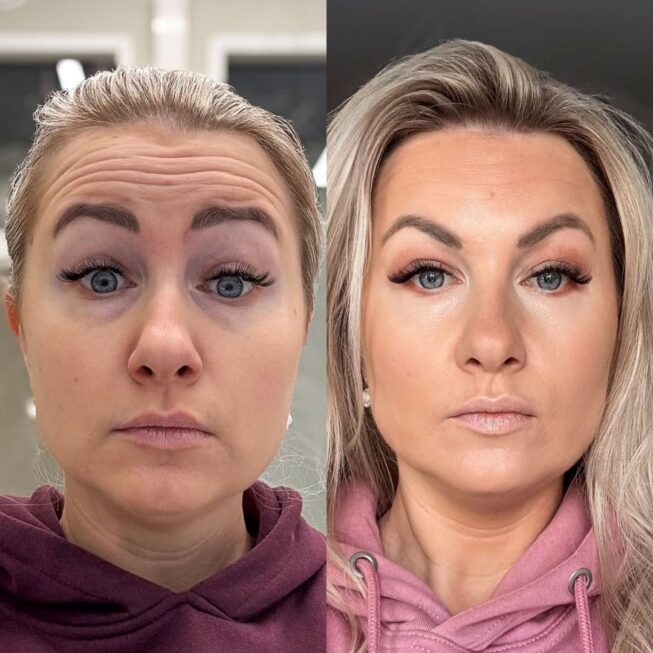 botox-otsaan-ville-mannisto-5