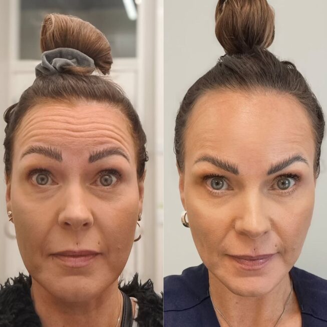 botox-otsaan-ville-mannisto-6
