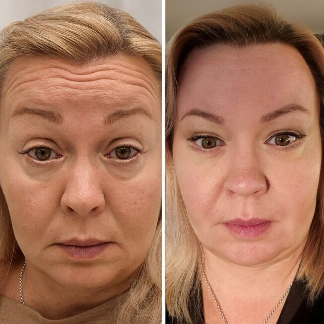 botox-otsaan-ville-mannisto