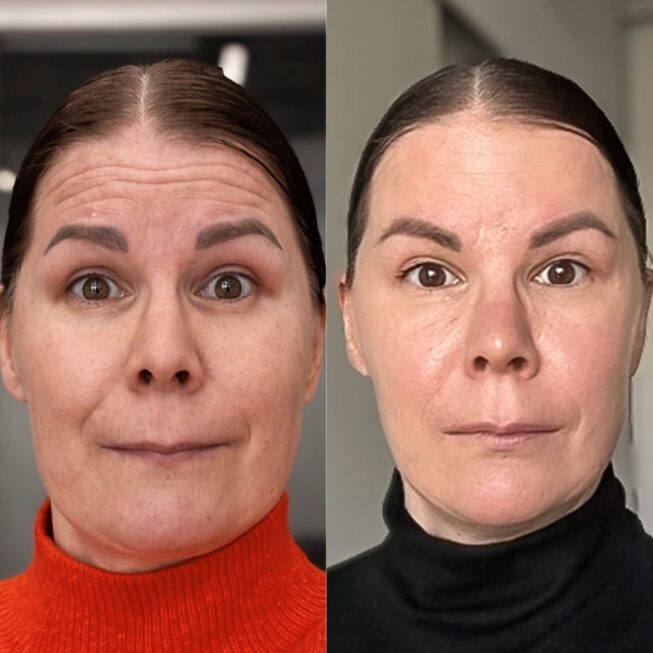 botox-otsaan-ville-mannisto-7