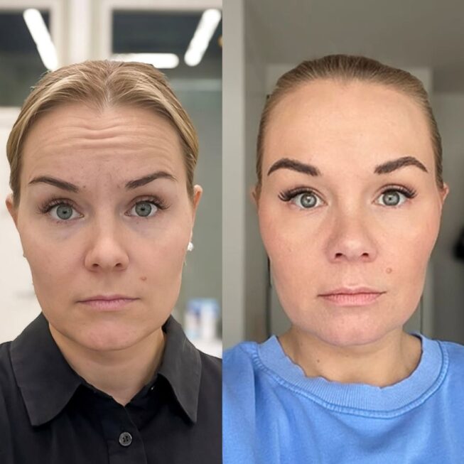 botox-otsaan-ville-mannisto-8