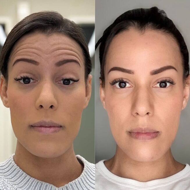 botox-otsaan-ville-mannisto-9