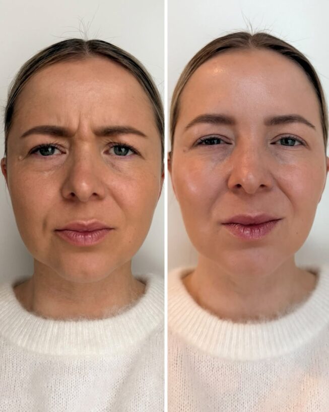 botox-sibeliusryppy-ennen-jalkeen-4