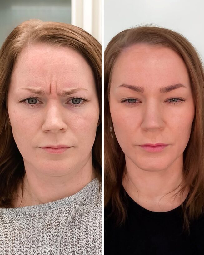 botox-sibeliusryppy-ennen-jalkeen-5