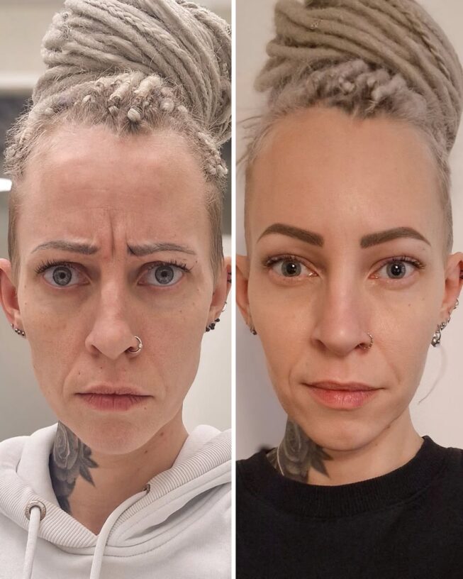 botox-sibeliusryppy-ennen-jalkeen-6