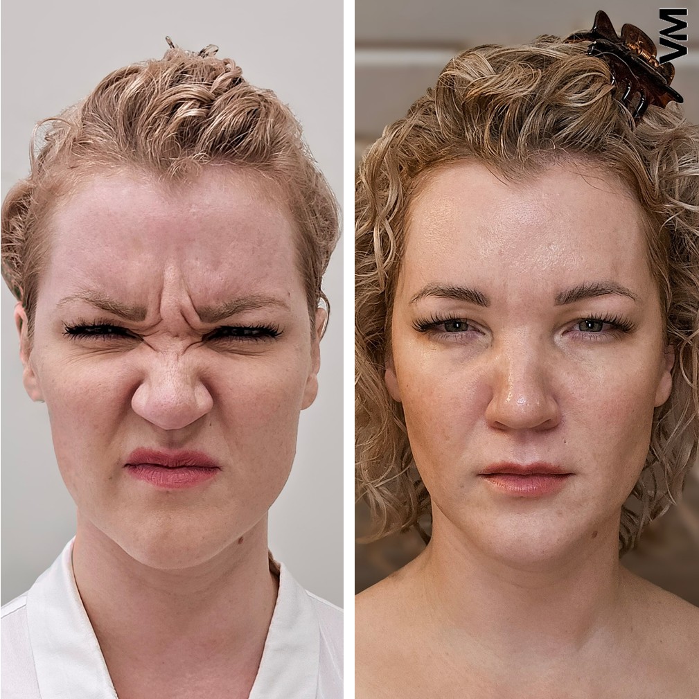 botox sibeliusryppy helsinki ennen jälkeen