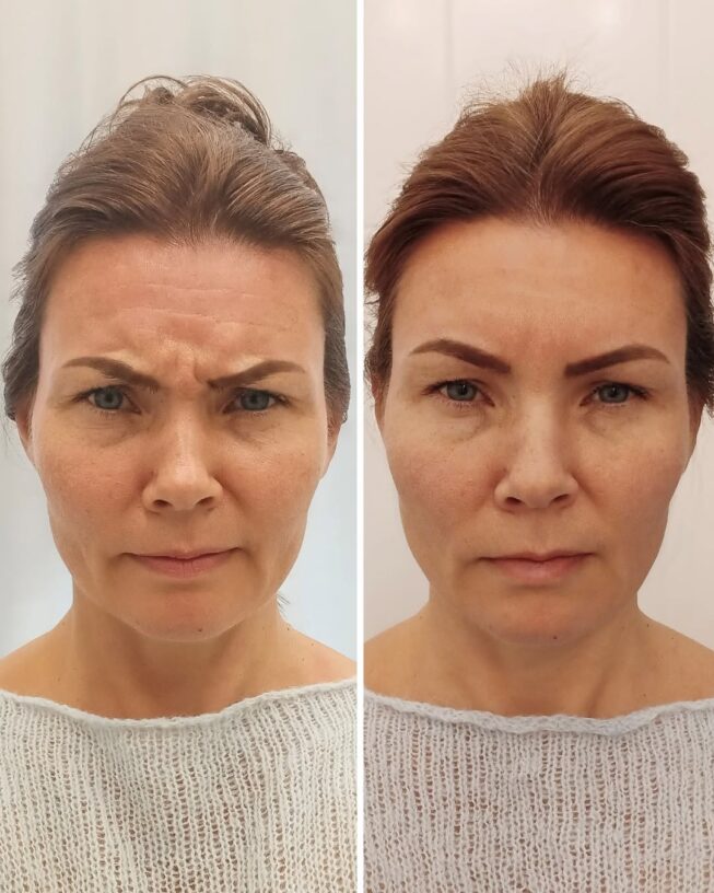 botox-sibeliusryppy-hinta-270-euroa