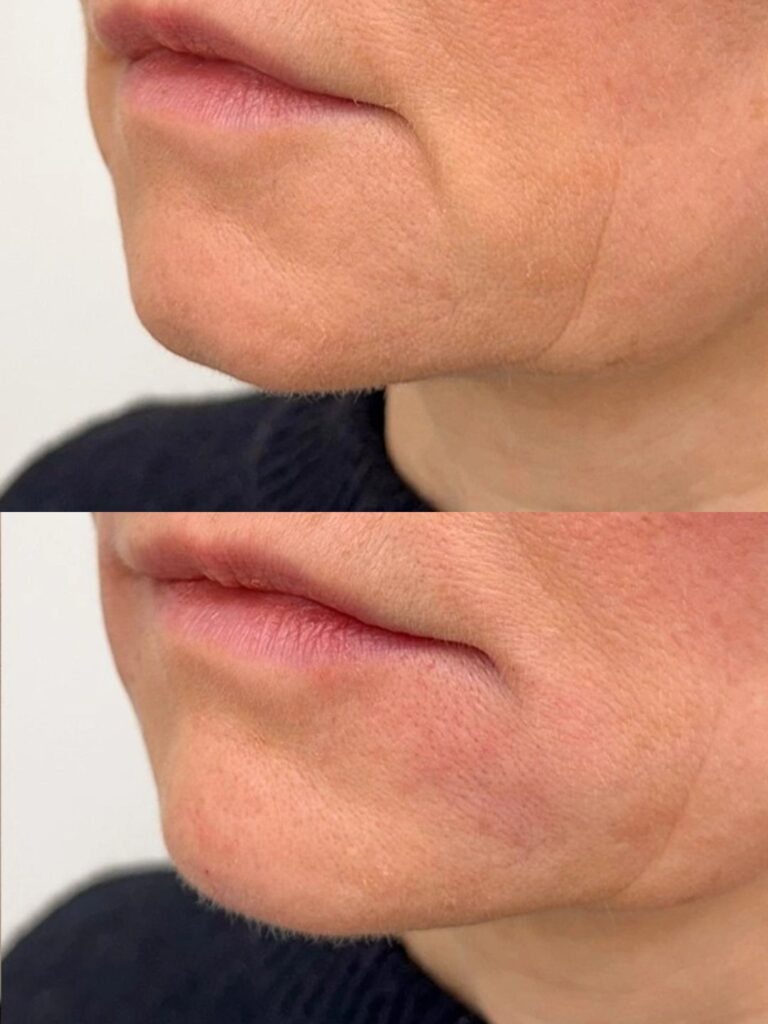 botox suupielet
