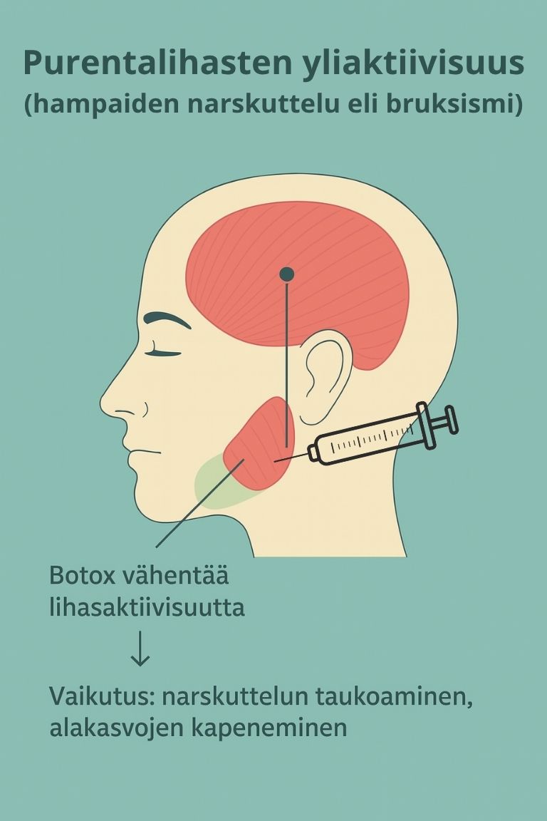 Botoxin vaikutus purentalihaksiin