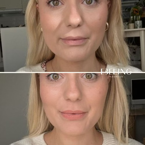 bruksismi botox purentalihaksiin