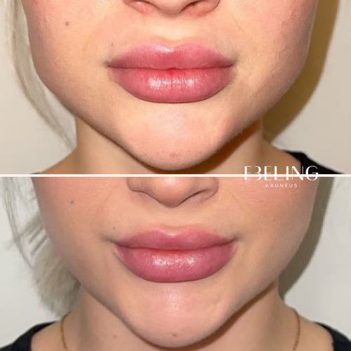 bruksismi botox tulos