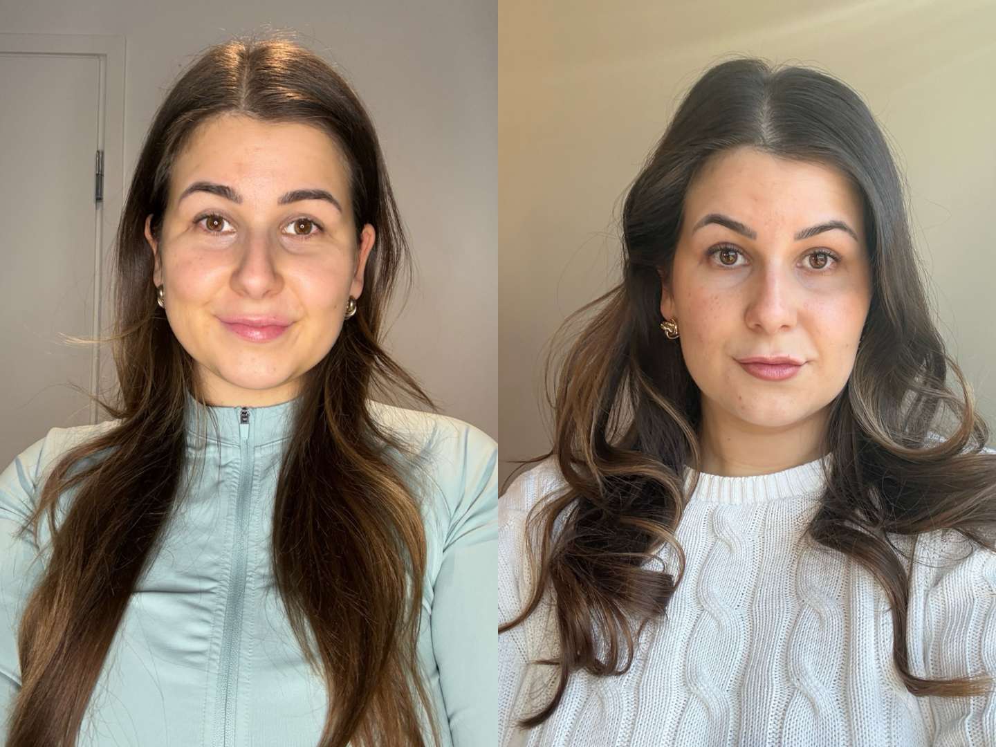 bruksismi botox kokemuksia