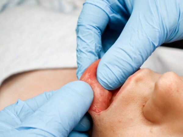 Lip Filler Removal – Ville Männistö Explains