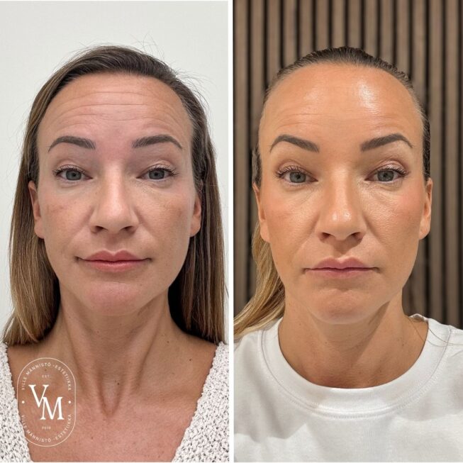 kulmien-kohotus-botox