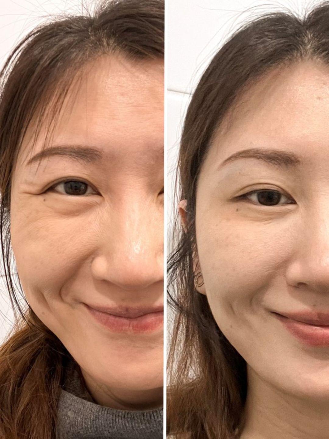 Botox for lifting the corners of the mouth