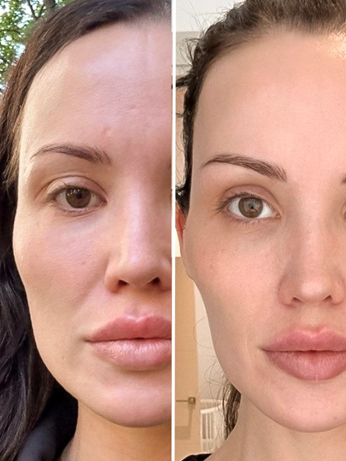 masseter botox suomi ennen jälkeen