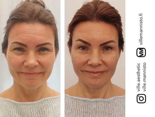 onnistunut botox ennen jälkeen