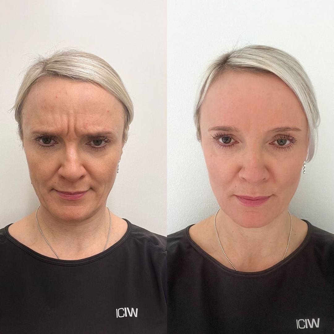 sibeliusryppy botox tampere