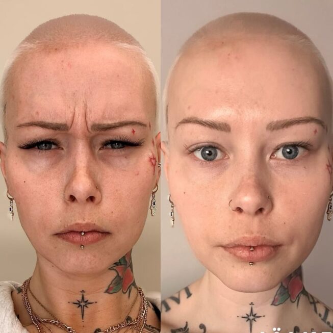 sibeliusryppy-botox-ville-mannisto-5