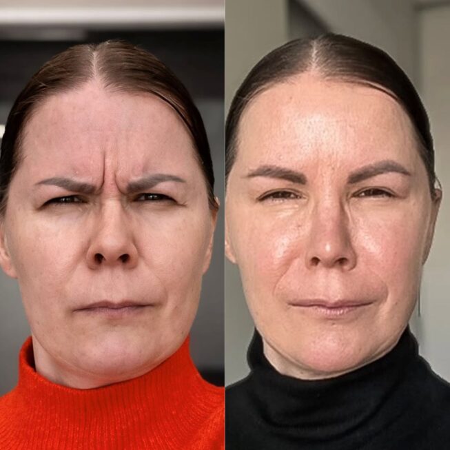 sibeliusryppy-botox-ville-mannisto-7