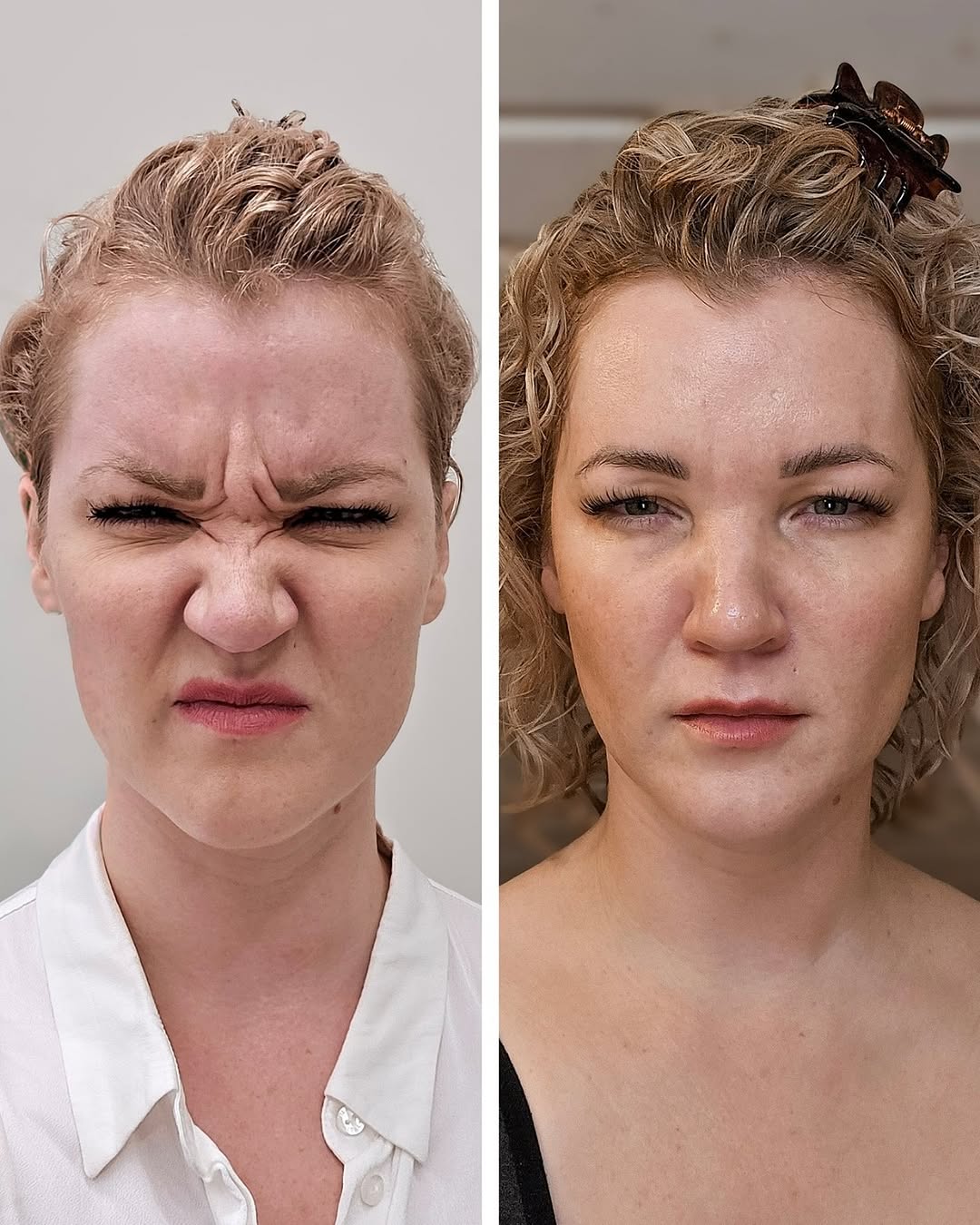 sibeliusryppy ennen jälkeen botox