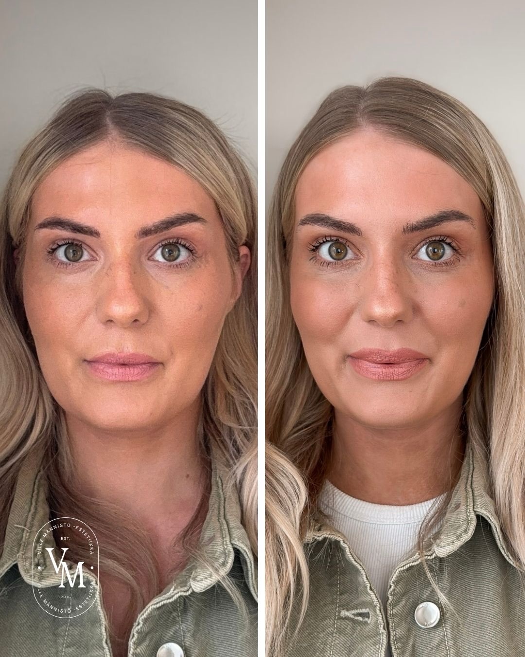 Botox for the Masseter Muscle: Before and After