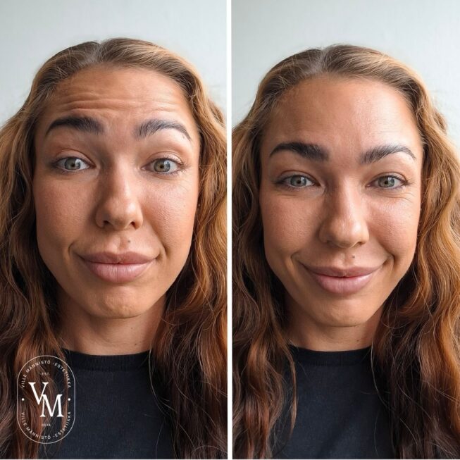 Botox on the forehead (1)