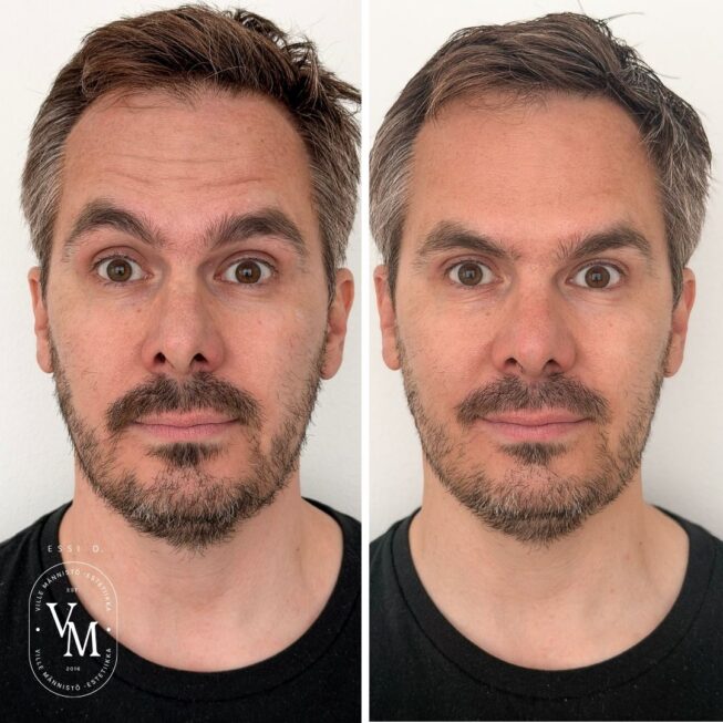 botox-on-the-forehead-essi-ojala (2)