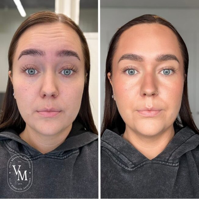 Botox-for-the-forehead-Helsinki-Tampere-Espoo