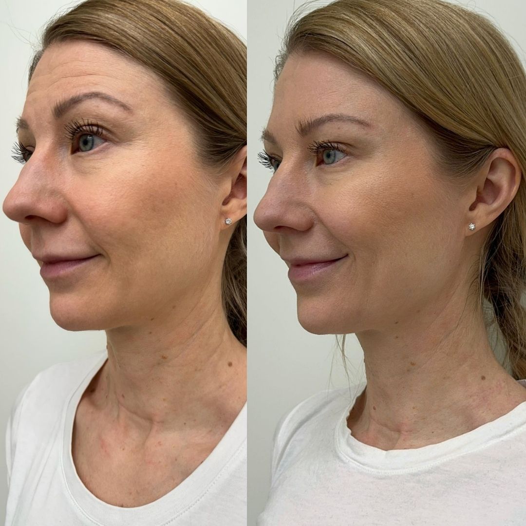 Full-Face Botox by Ville Männistö